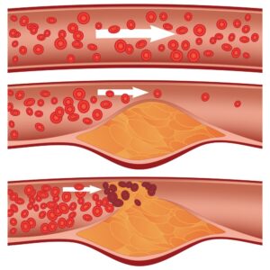 Níveis de colesterol no sangue