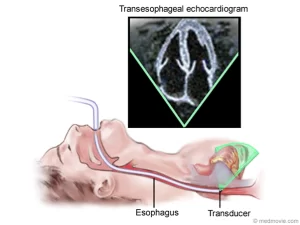 Cardiologista Copacabana - Dra Mariana Fogaça - Mostra como é feito o ecocardiograma transesofágico e Ecocardiografia com Doppler Colorido