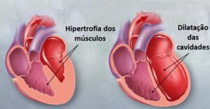Doença do Coração Grande Sintomas