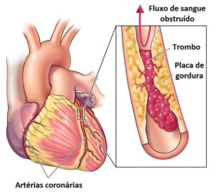 o que é ataque cardíaco ou infarto agudo do miocárdio diagnóstico e prevenção