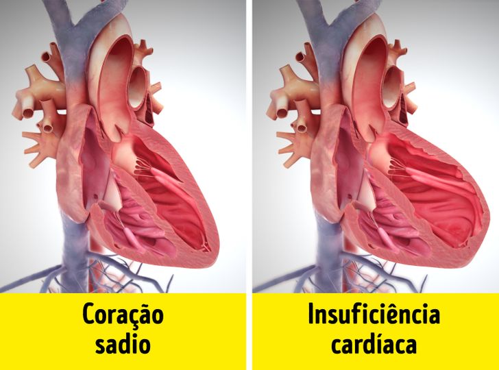 Como é feito o diagnóstico da insuficiência cardíaca, popularmente conhecida como “coração grande”