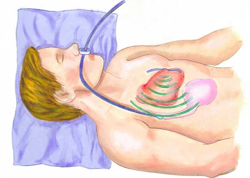 Ecocardiograma transesofágico é perigoso, como é feito, qual é o preparo
